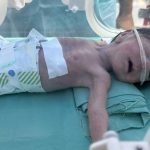 A malnourished baby is treated at the Al Helou Hospital in Gaza City.