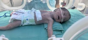 A malnourished baby is treated at the Al Helou Hospital in Gaza City.