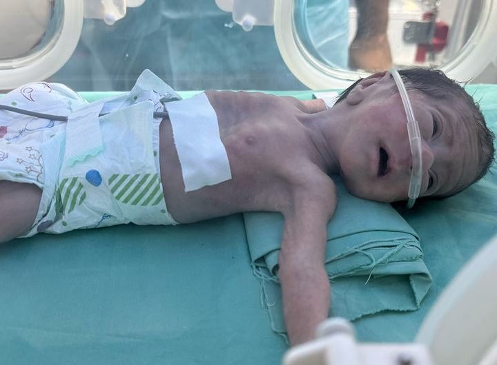 A malnourished baby is treated at the Al Helou Hospital in Gaza City.
